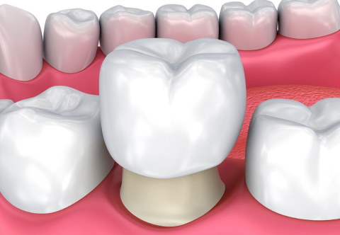 Bọc Răng Sứ Là Gì? Có Mấy Loại Răng Sứ 