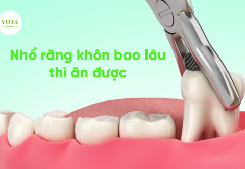 Nhổ Răng Khôn Bao Lâu Thì Ăn Được Bình Thường 