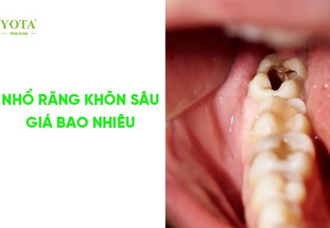 Chi Phí Nhổ Răng Khôn Bị Sâu Mới Nhất Năm 2025