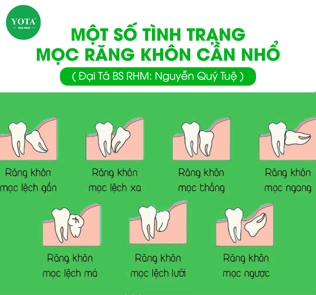 nhổ răng khôn ảnh 1