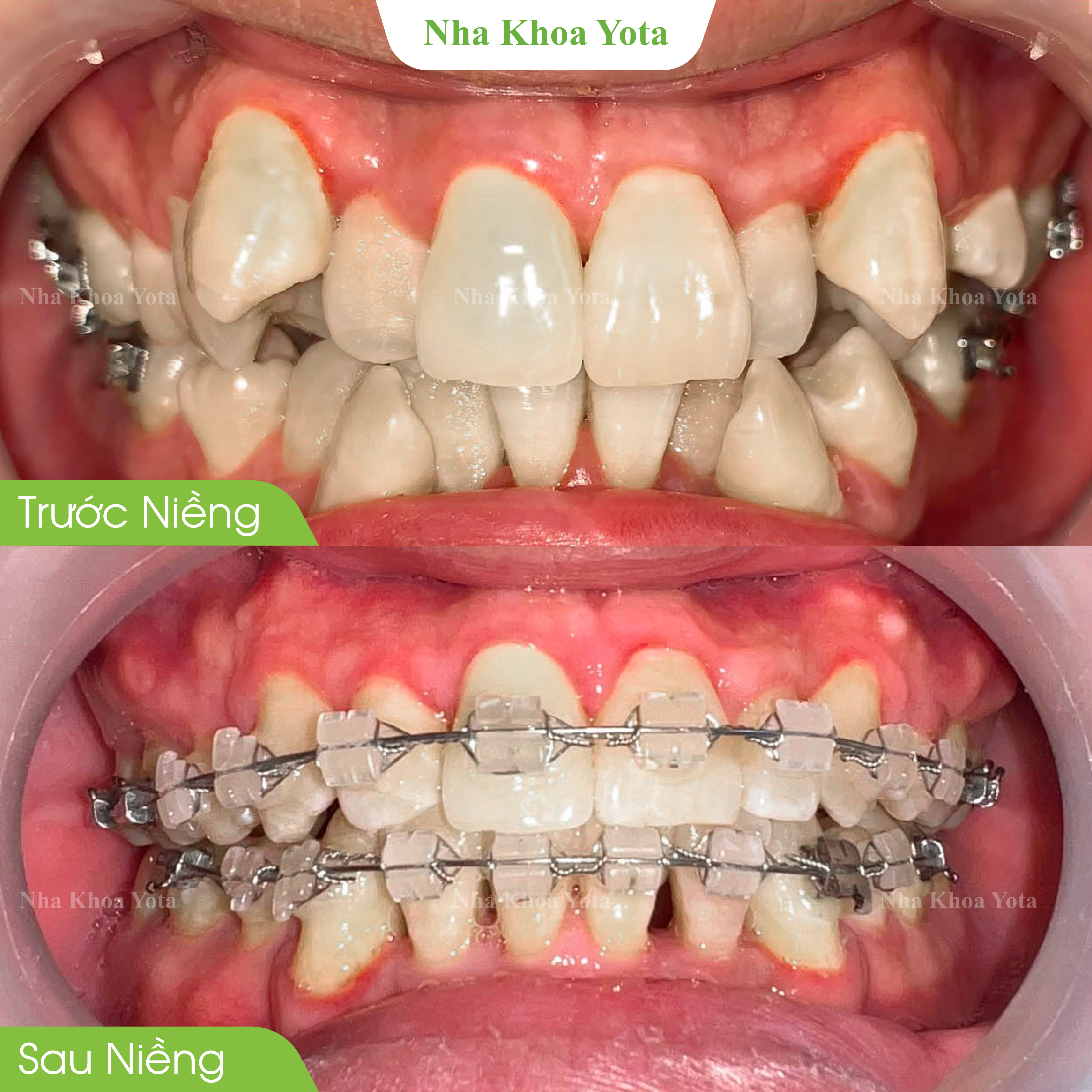 niềng răng ảnh 3