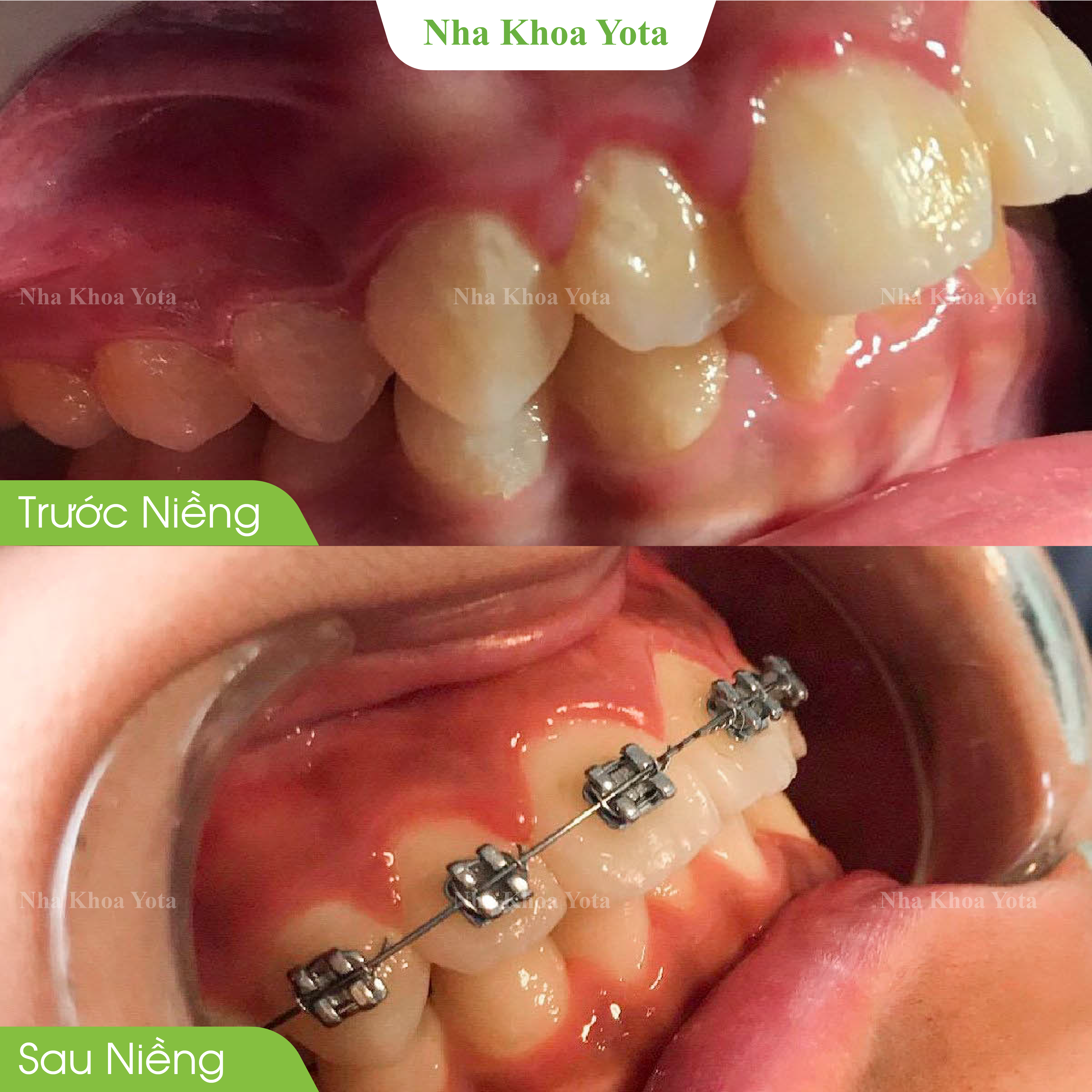 niềng răng ảnh6