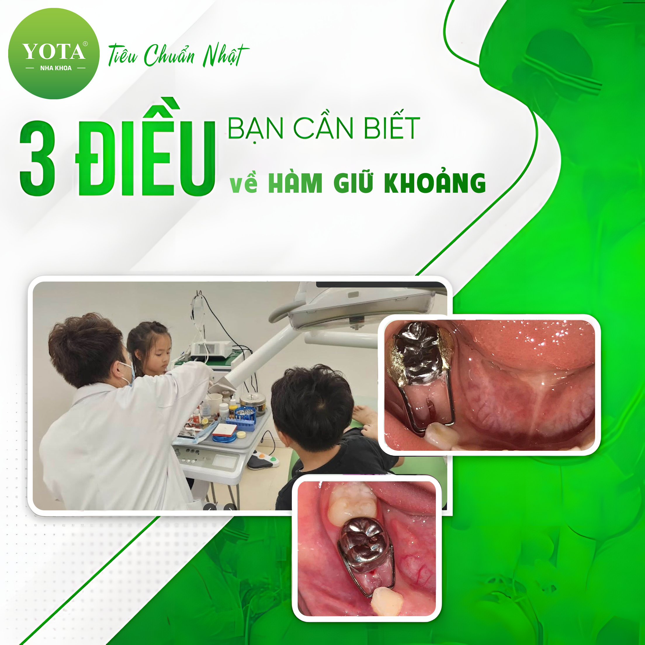 hàm giữ khoản anh 1