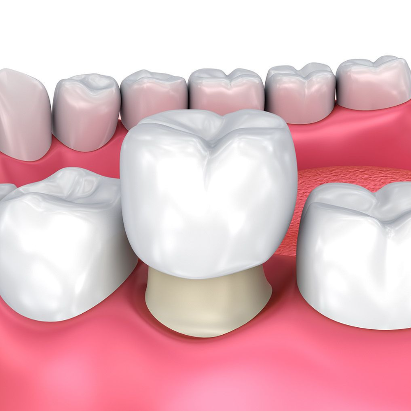 Bọc răng sứ là gì ảnh 3