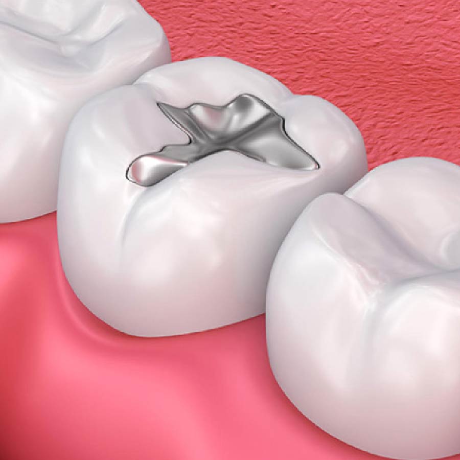 hàn răng amalgam