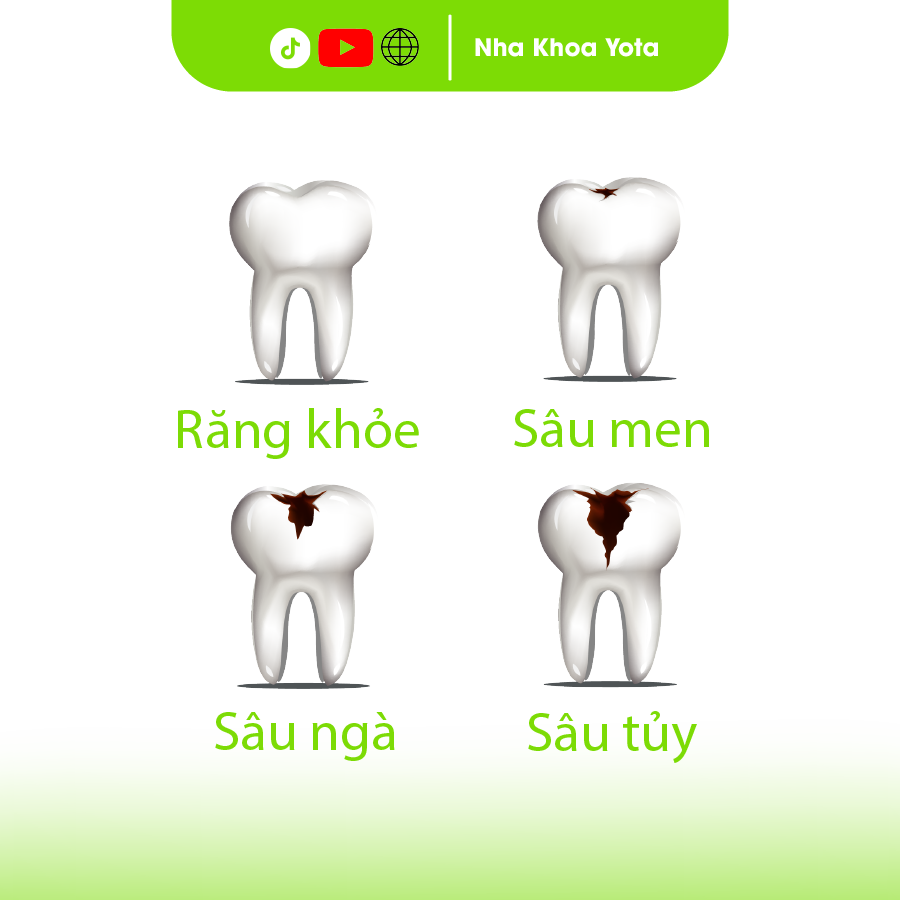 hàn răng sâu không đau ảnh 1