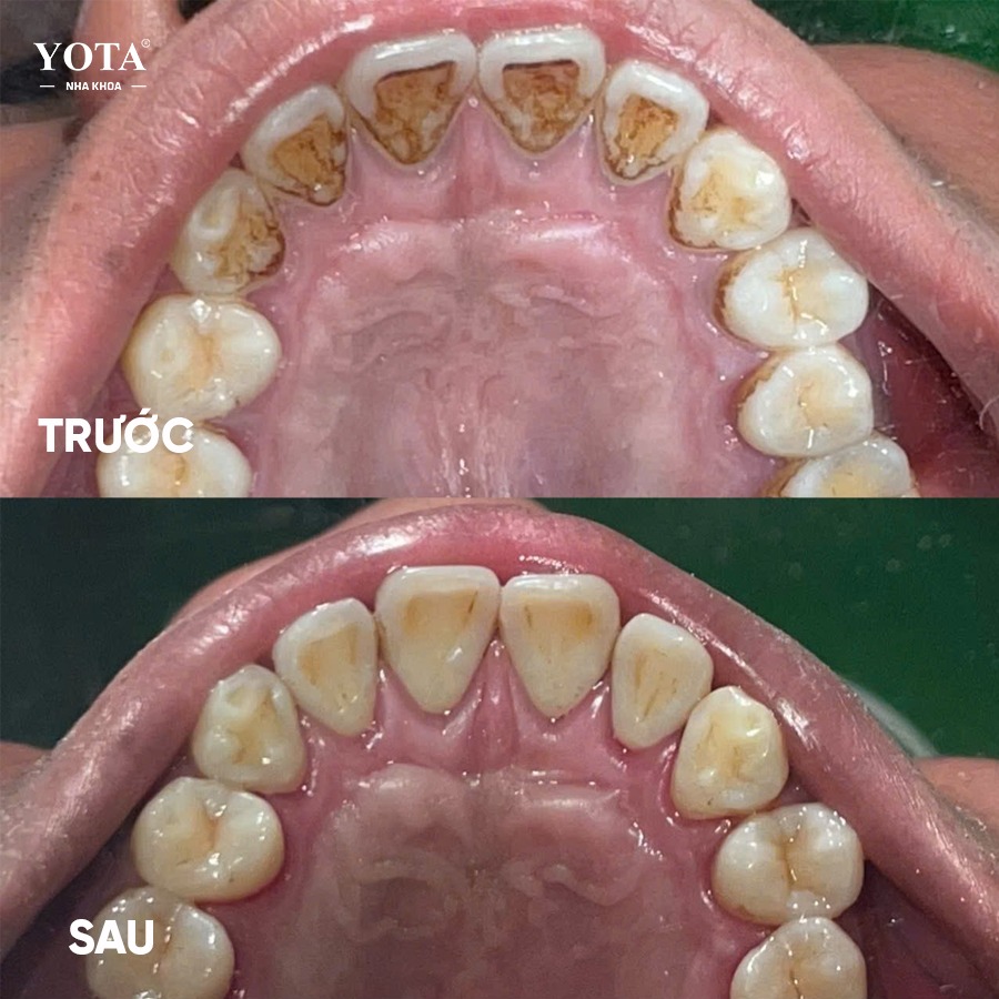 lấy cao răng mất bao lâu ảnh 4