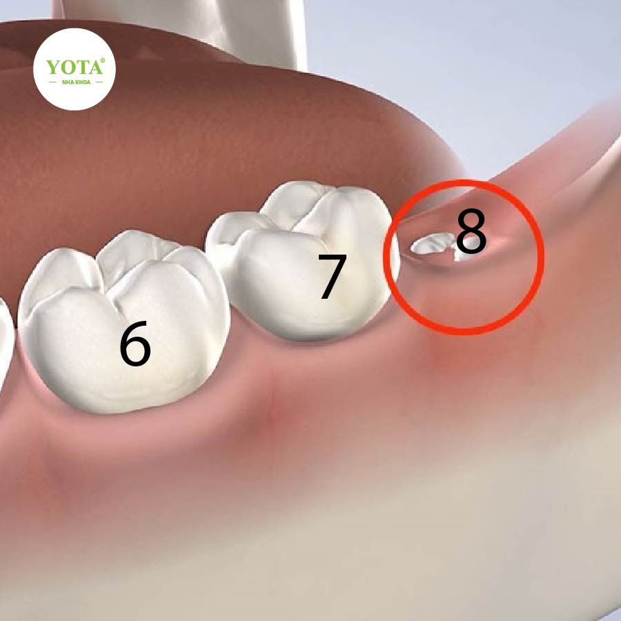 nhổ răng khôn là gì