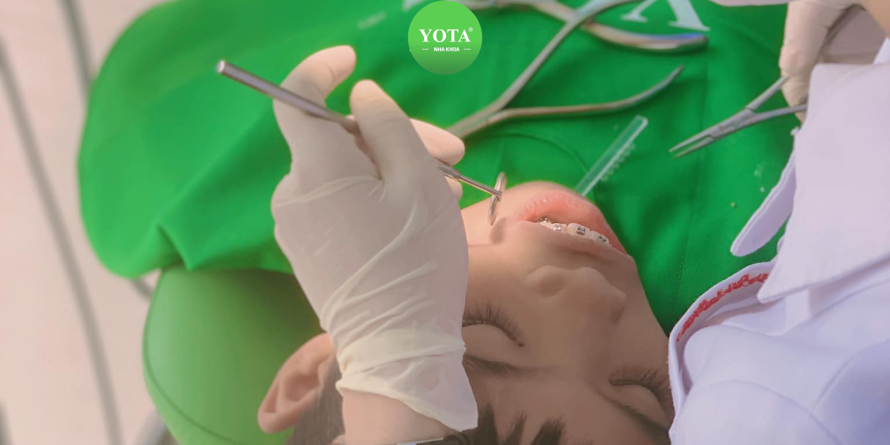 niềng răng mắc cài