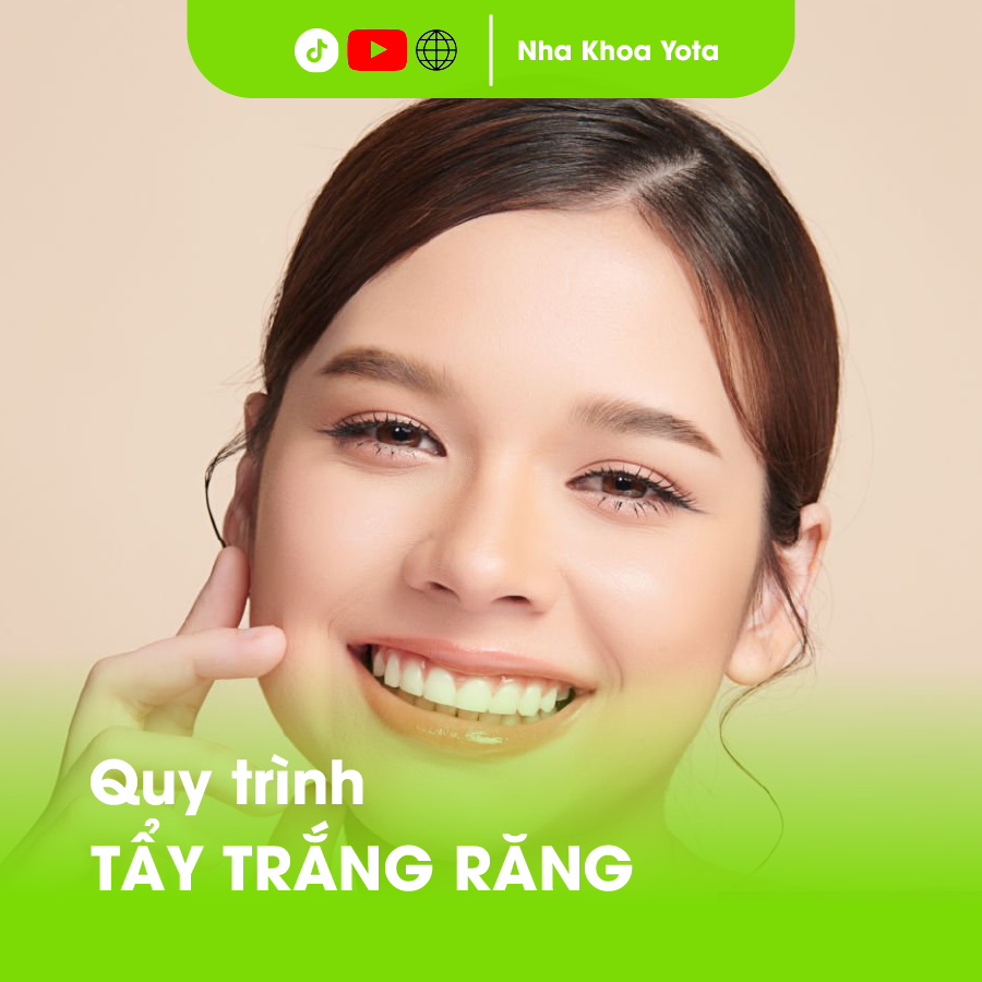 quy trình tẩy trắng răng