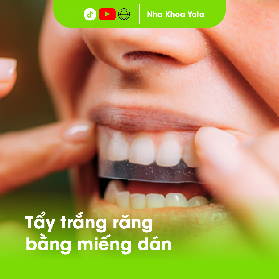 tẩy trắng răng bằng miếng dán