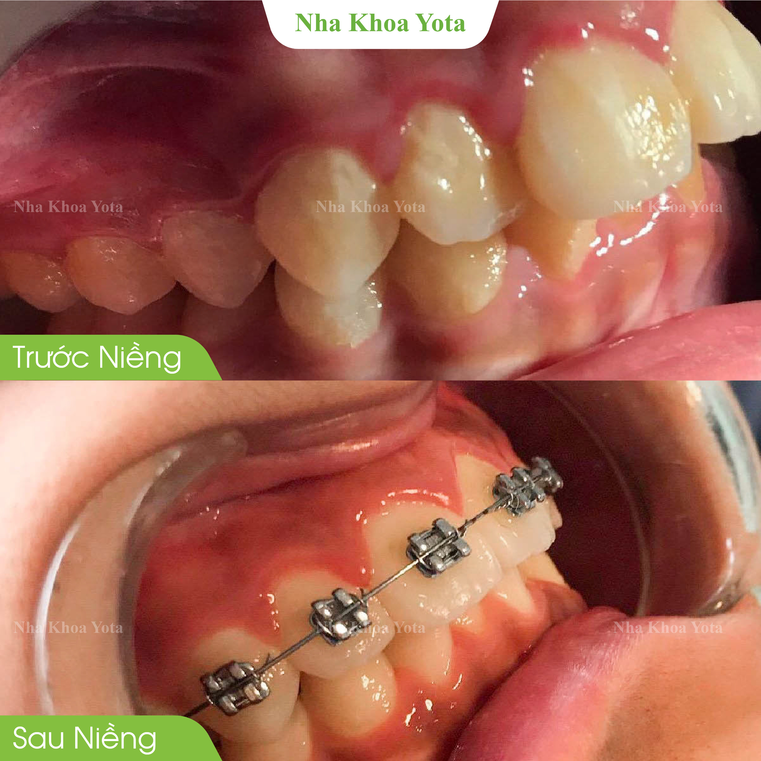 Trước và sau niềng răng ảnh 4