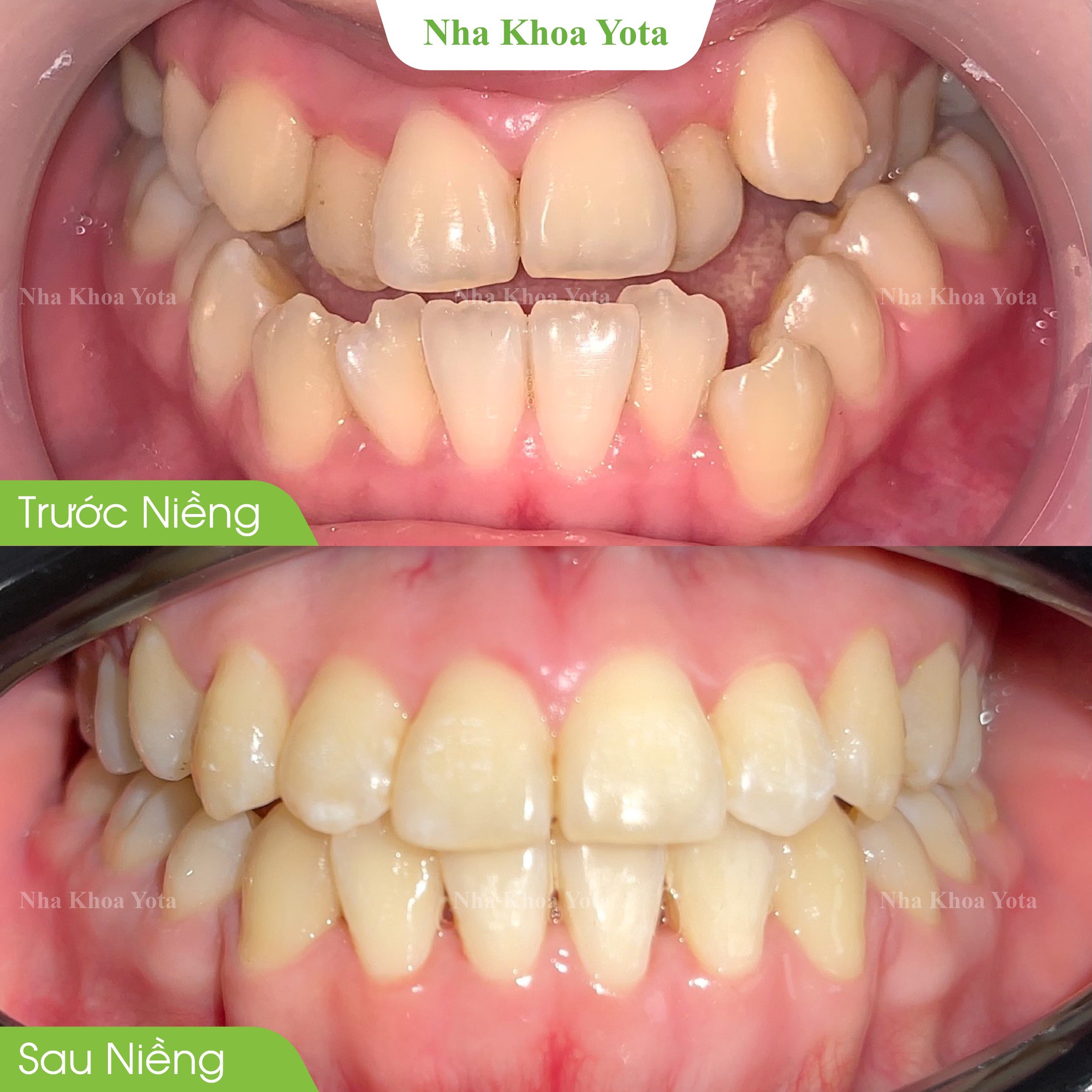 Trước và sau niềng răng ảnh 5