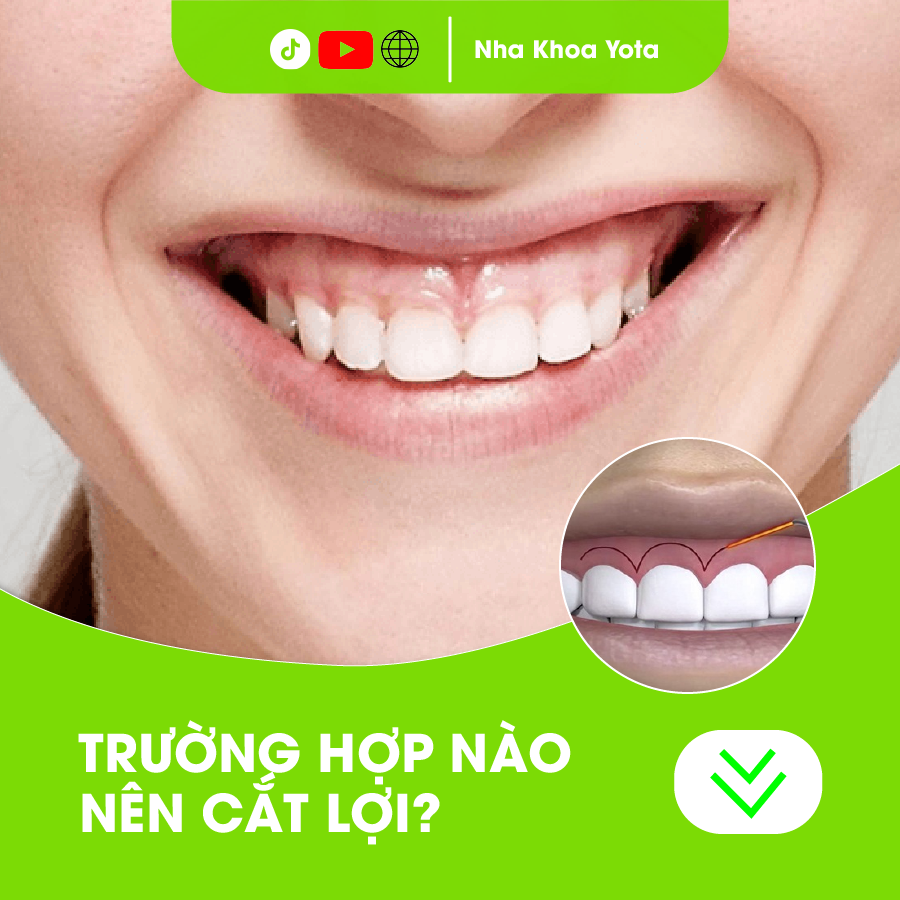 cắt lợi là gì ảnh 2