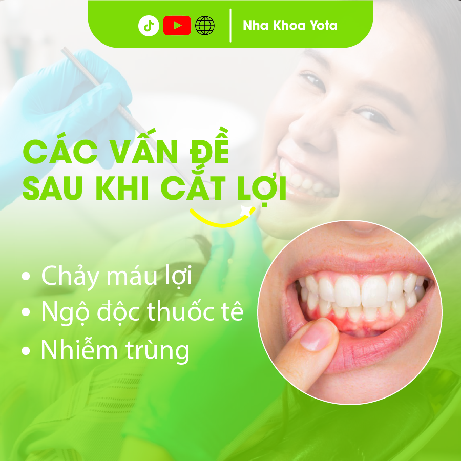 cắt lợi là gì ảnh 3